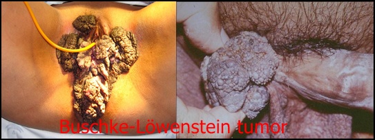 Buschke-Löwenstein tumor